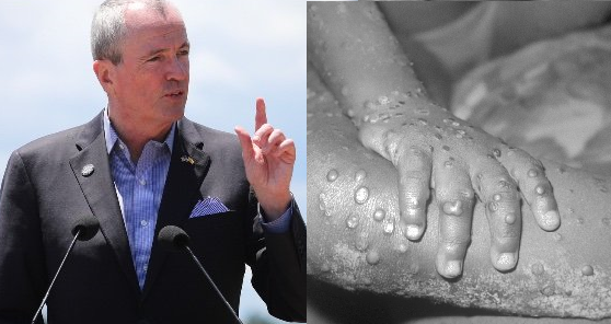 Murphy confirms first “probable” N.J. case of monkeypox